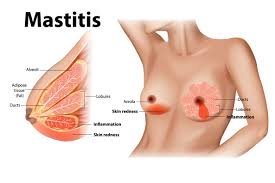 Mastitis-Infection Mastitis-Infection