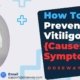 How-To-Prevent-Vitiligo