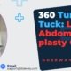 360-Tummy-Tuck