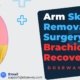 Arm-Skin-Removal-Surgery-Brachioplasty-Recovery