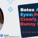 Botox-Around-Eyes