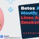Botox-Around-Mouth