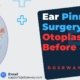 Ear-Pinning-Surgery