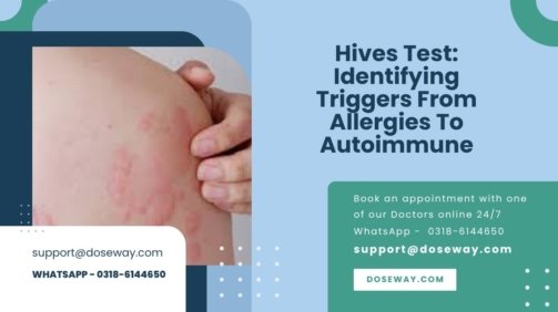Hives-Test-Identifying-Triggers-From-Allergies-To-Autoimmune