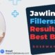 Jawline-Fillers
