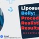 Liposuction-Belly