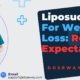 Liposuction-For-Weight-Loss