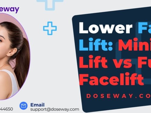 Lower-Face-Lift