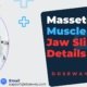 Masseter-Muscle-Botox