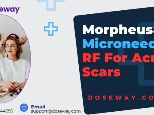 Morpheus8-Microneedling-RF-For-Acne-Scars.jpg